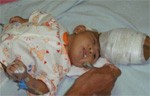 Operasi II Gagal, Bayi Tsunami Hydrocephalus Meninggal 